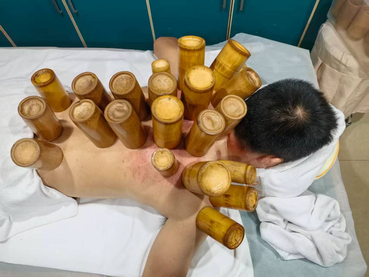 为治“昏沉困”去拔罐,结果:罐印留了,困意半点没走